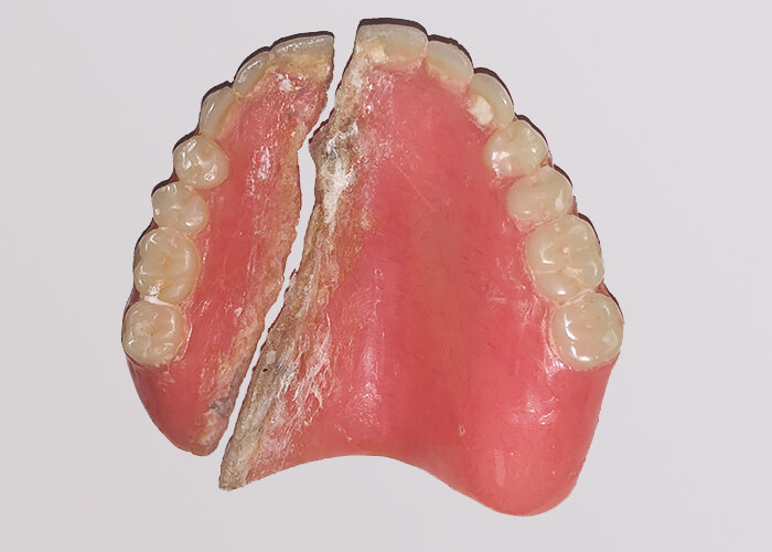 denture has been glued and cannot be fixed